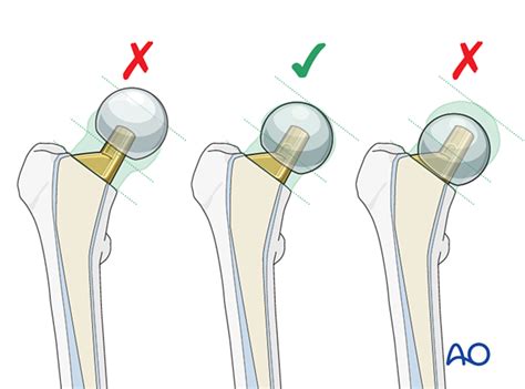 hip hemiarthroplasty orthobullets|AO Foundation Surgery Reference.